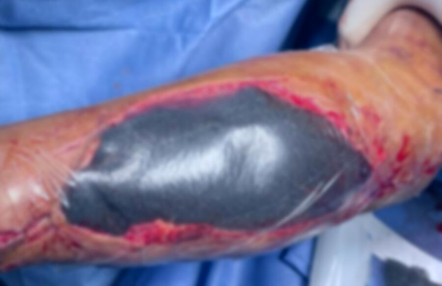 Terapia de heridas por presión negativa (VAC)