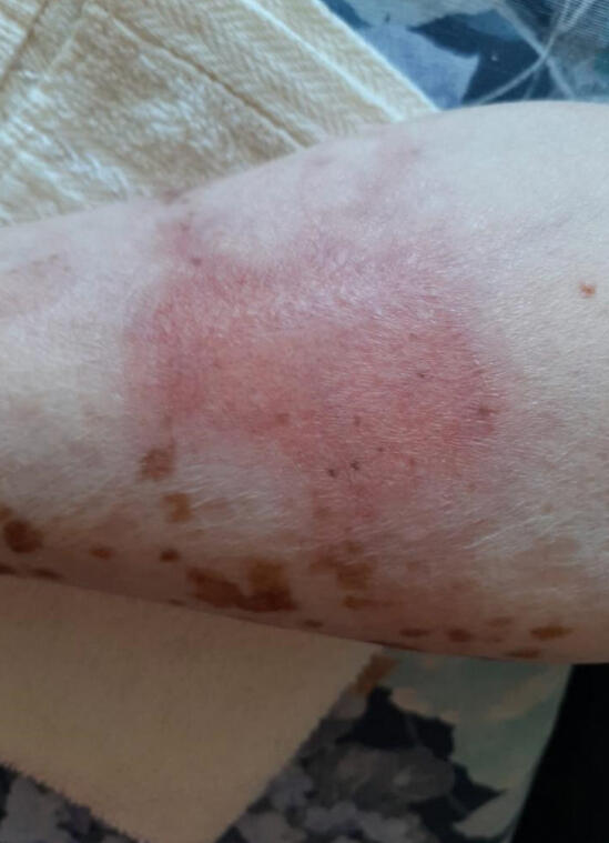 4 semanas de tratamiento