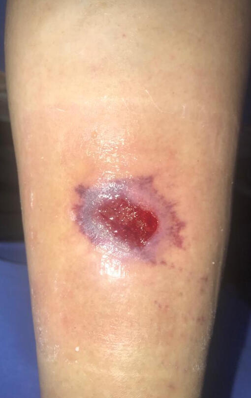 6 semanas de tratamiento